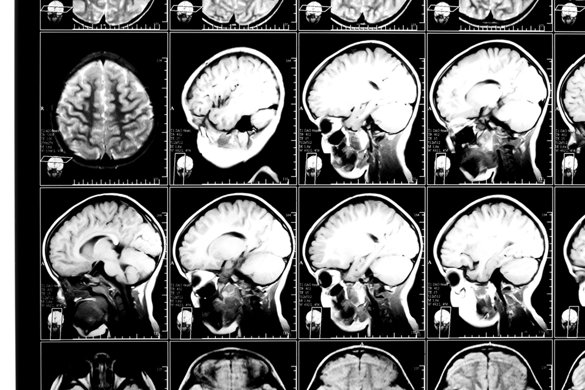 MRI brain scan (Nata-Lia / Shutterstock)