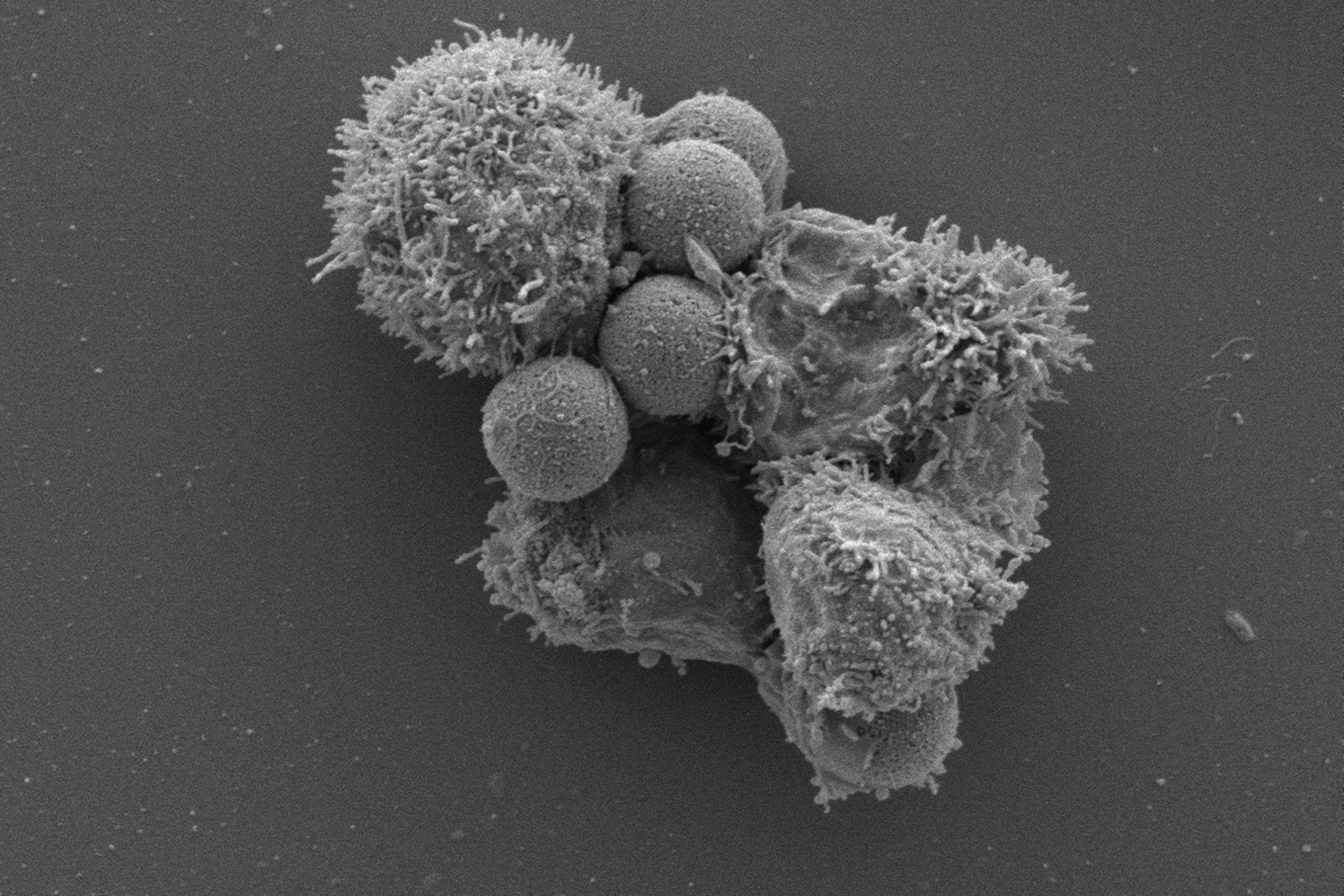 A designer T cell in manufacturing at the University of Pennsylvania. Sample preparation by the Electron Microscopy Resource Laboratory of the Perelman School of Medicine.