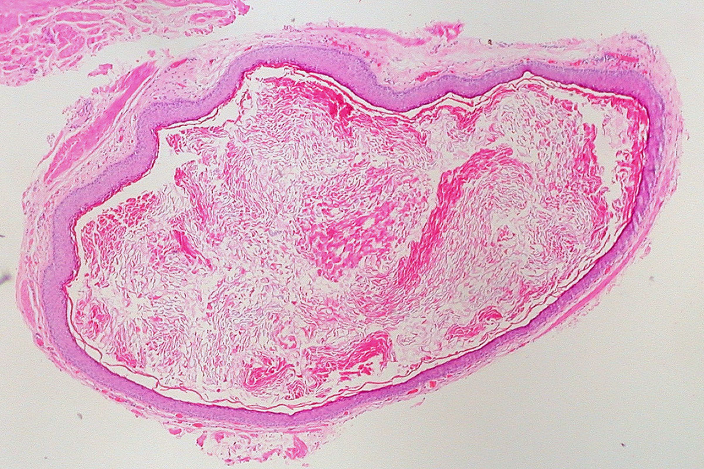 An epidermoid cyst, stained and under the microscope