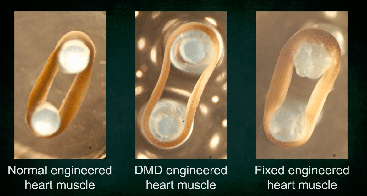 Genome editing corrects the cardiac abnormalities in patient’s engineered heart tissue. 