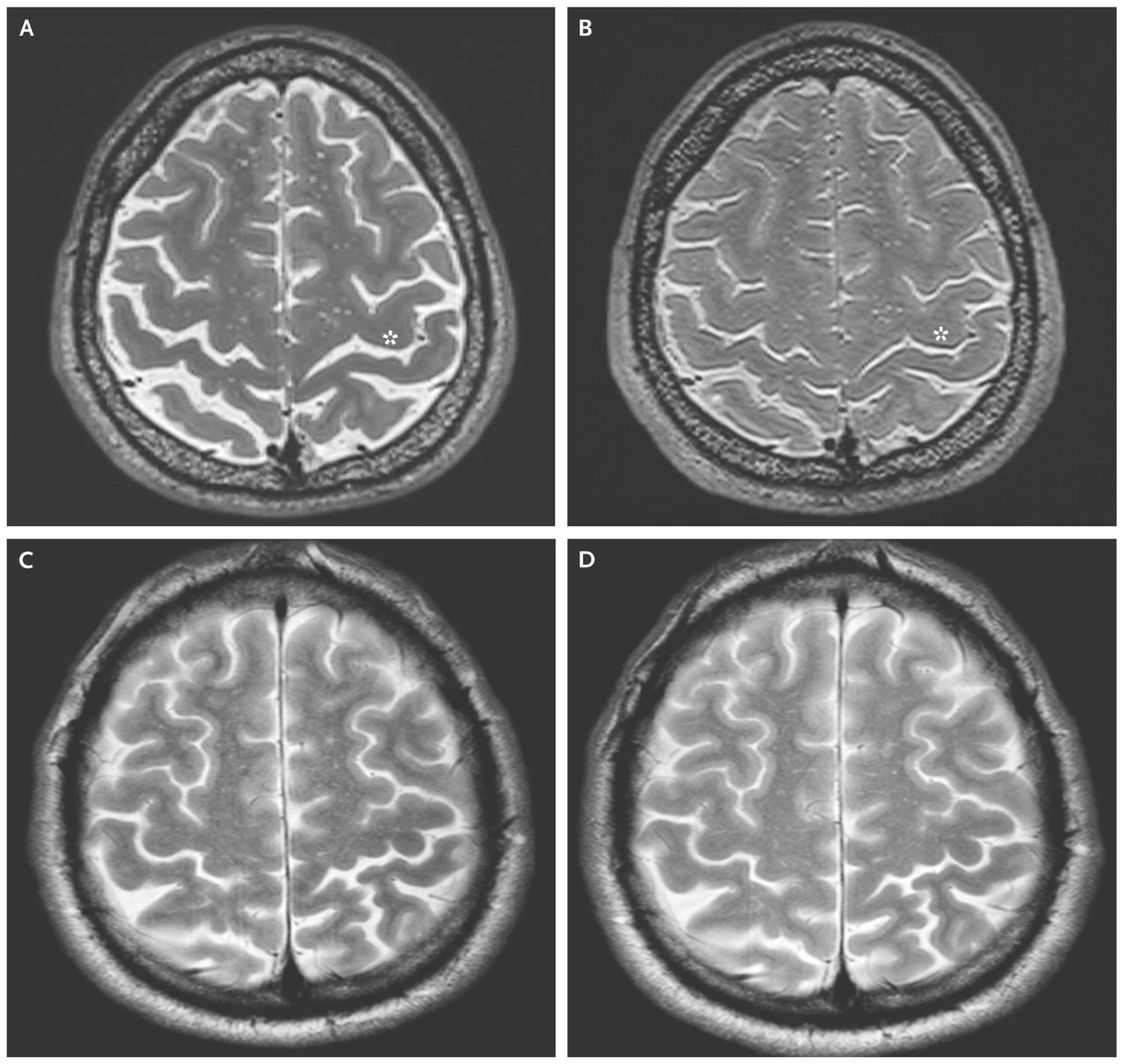 Brain images taken before and after spaceflight. Panels A and B show the before and after MRI scans from a long-duration spaceflight astronaut. Panels C and D show the before and after scans of a short-duration spaceflight astronaut.