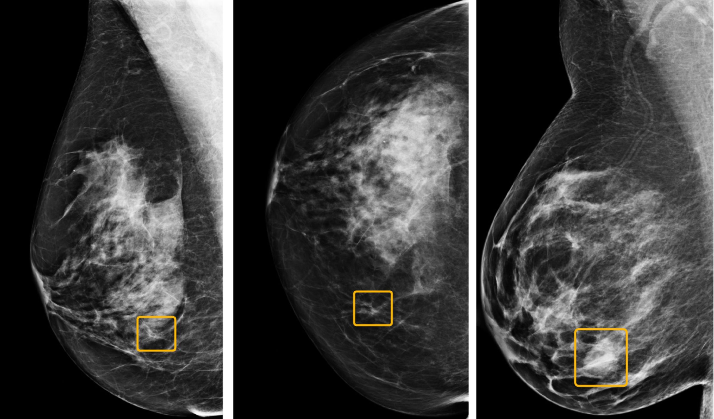 Google’s algorithm can spot lesions in mammograms more reliably than some doctors, but how should that be applied? 