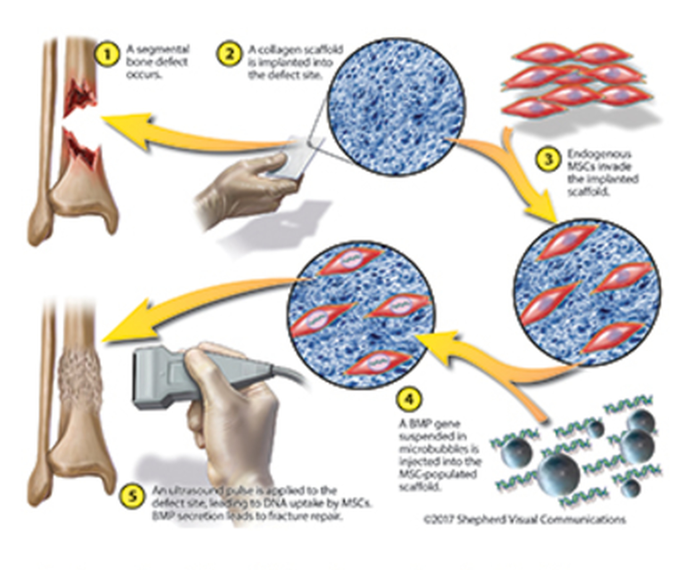 Cartoon schematic explaining ultrasound delivery method for gene therapy
