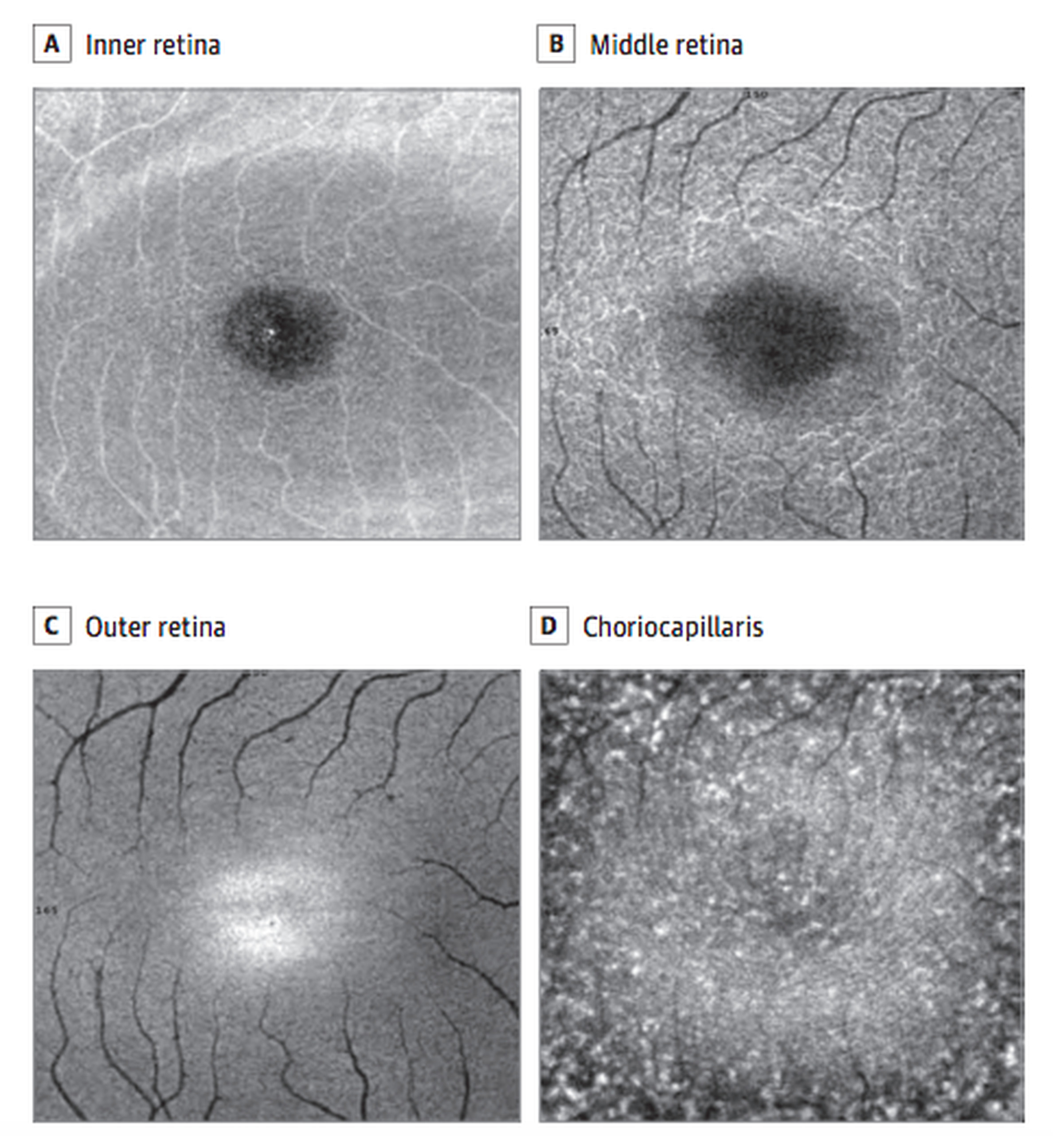 Images of eye damage after staring at the sun.