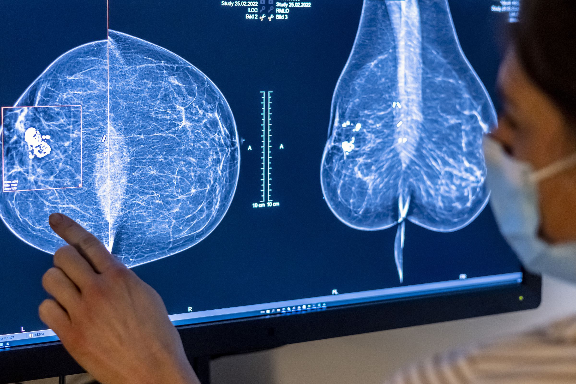 A person points to an image of a woman’s breast tissue from a mammogram.