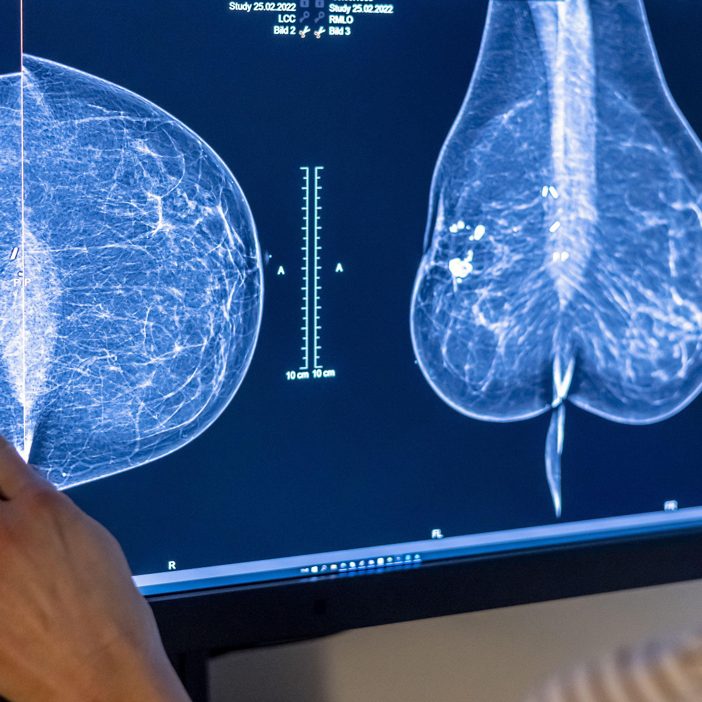 A person points to an image of a woman’s breast tissue from a mammogram.