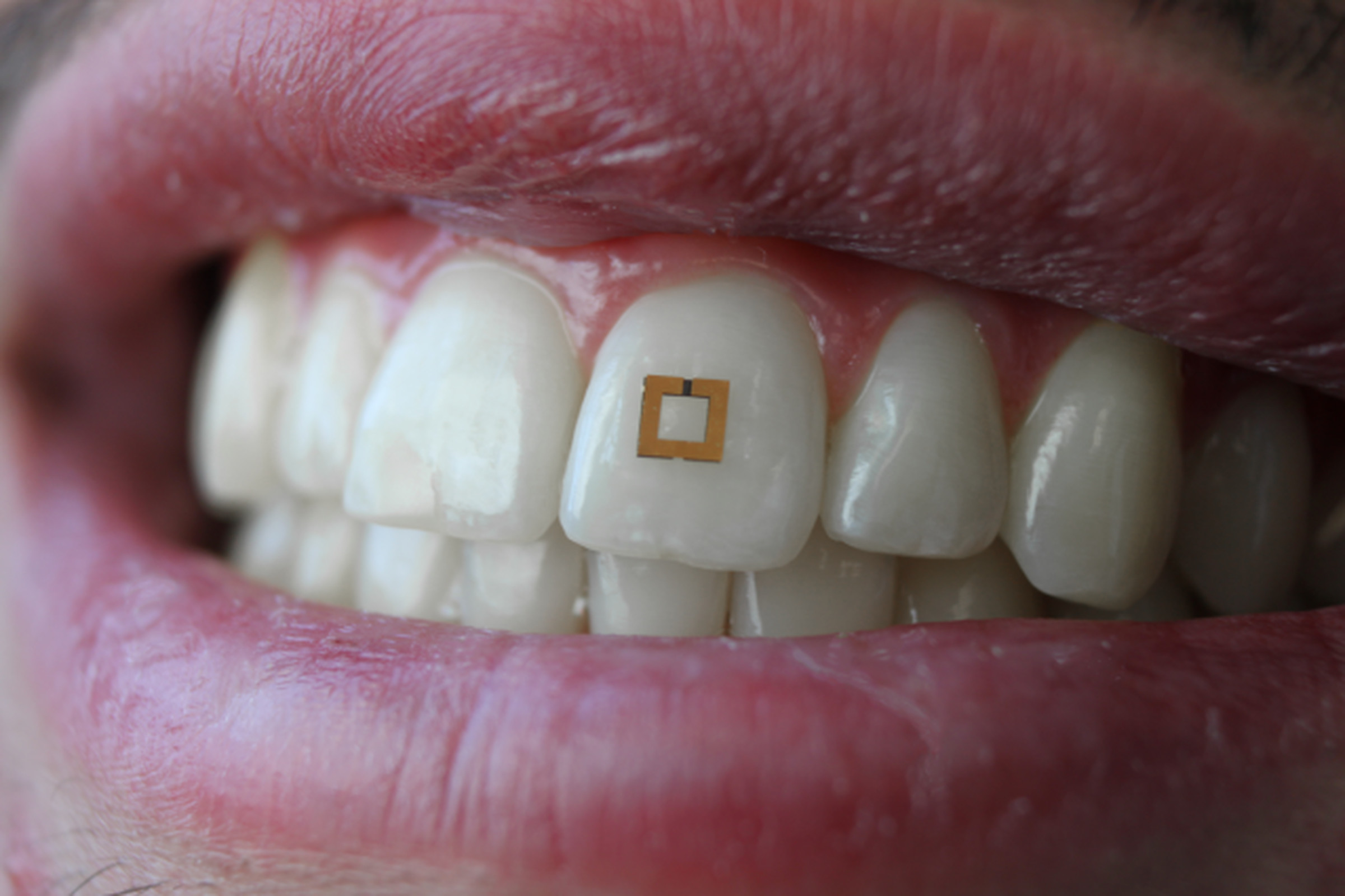 A tooth-mounted sensor that can monitor glucose, alcohol, and salt.