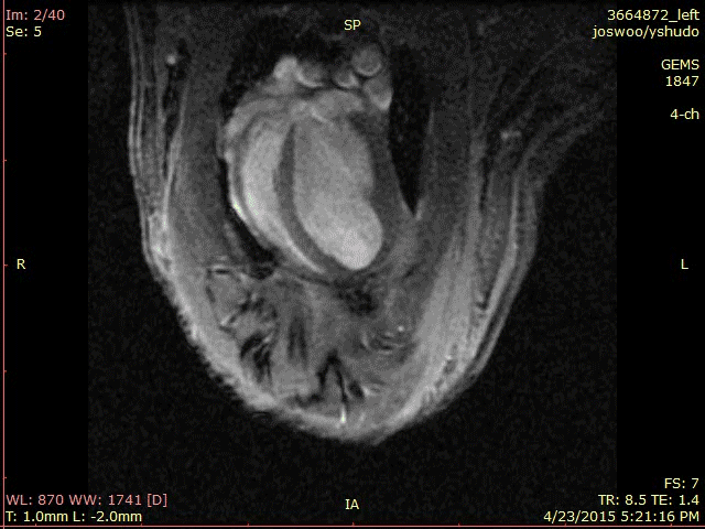 An MRI of a rat heart after it’s been treated with S. elongatus.