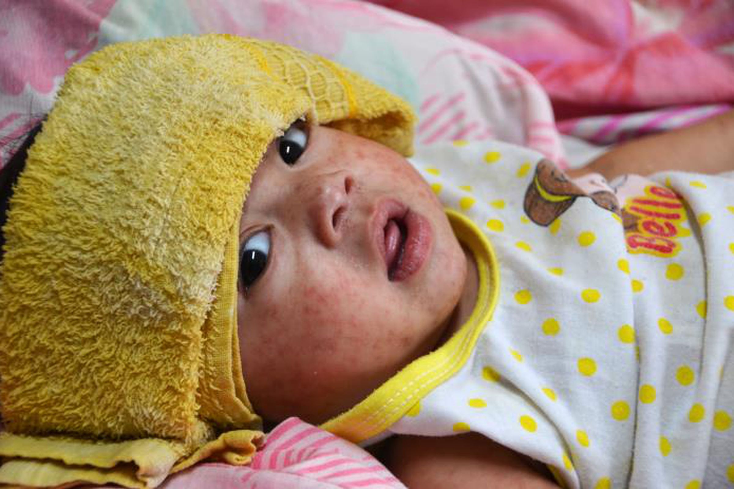 Measles is known for causing rashes — like the one affecting this child in the Philippines in 2014.
