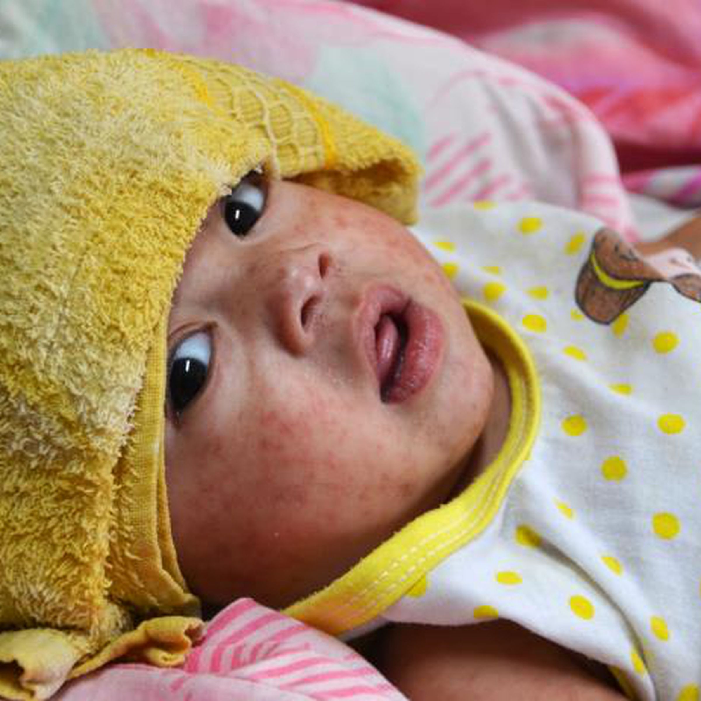 Measles is known for causing rashes — like the one affecting this child in the Philippines in 2014.