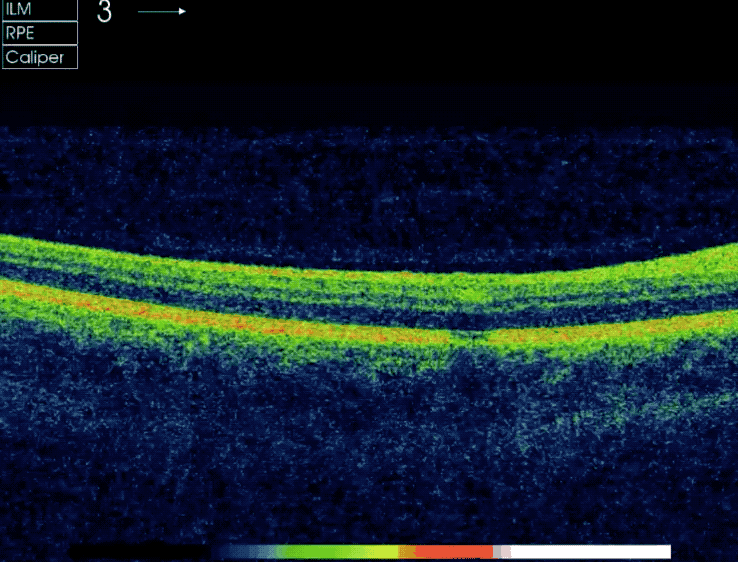 An example of an OCT scan, showing the thickness of retinal tissue in a patient’s eye. 