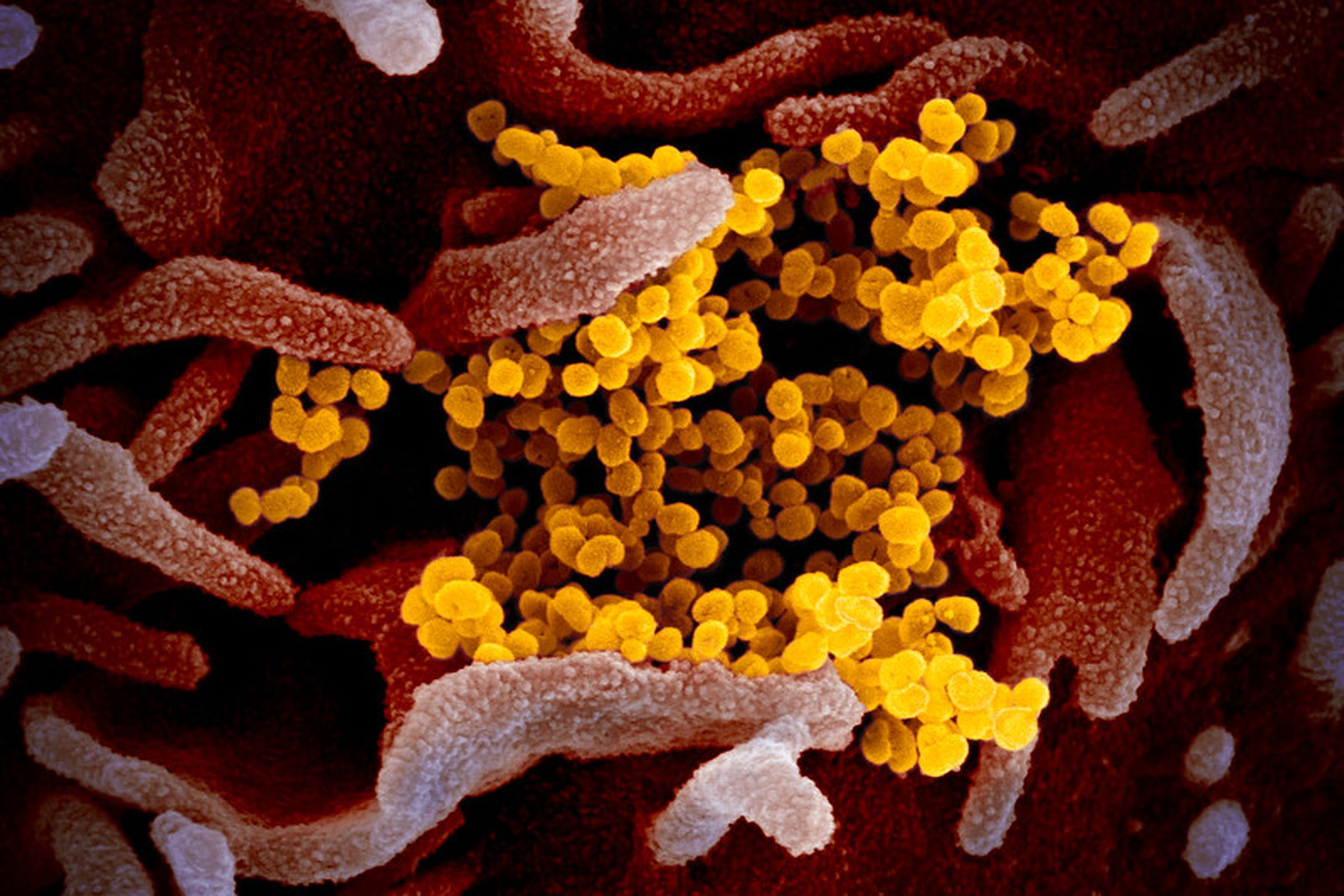 The new coronavirus (yellow), isolated from a patient in the US. 